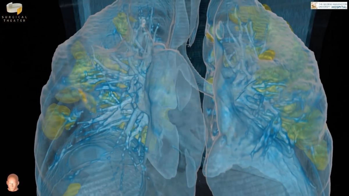 Скільки часу легені відновлюються після коронавірусу