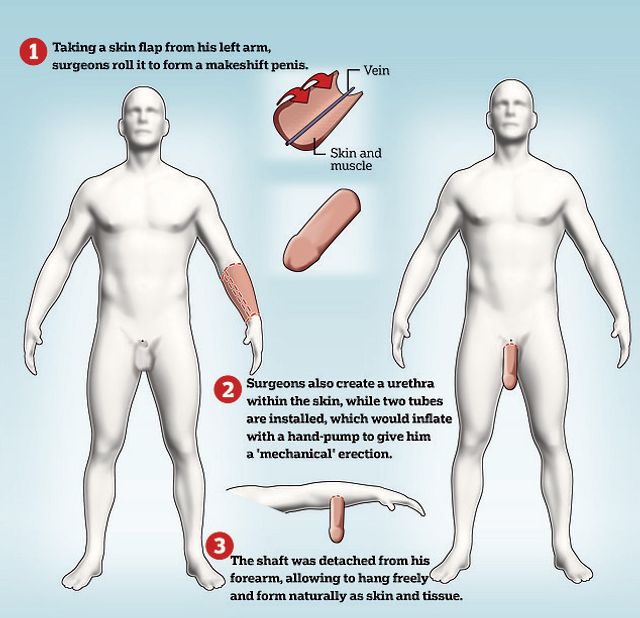 Уперше в історії чоловікові вдалося виростити пеніс на... руці - фото 418569