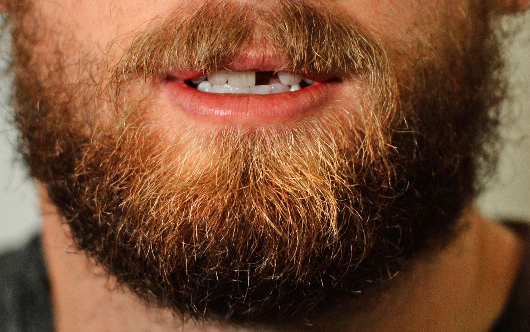 Дырка в зубе: почему появилась и как ее лечить