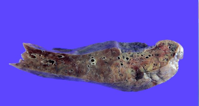 Як виглядають легені, уражені COVID-19: фото не для слабкодухих - фото 420569