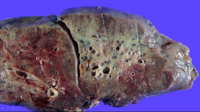 Як виглядають легені, уражені COVID-19: фото не для слабкодухих - фото 420570