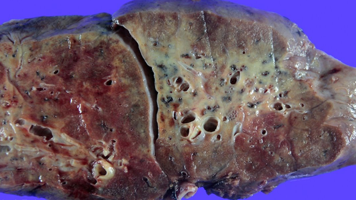 Як виглядають легені, уражені COVID-19: фото не для слабкодухих