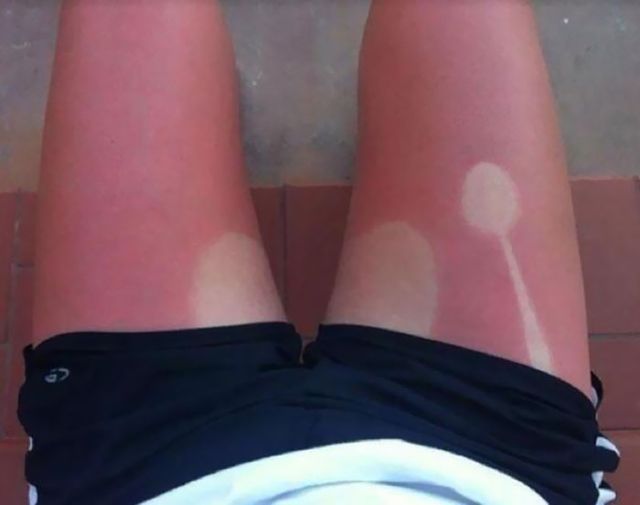 Користувачі мережі діляться смішними фото своєї невдалої засмаги: весела добірка - фото 421166