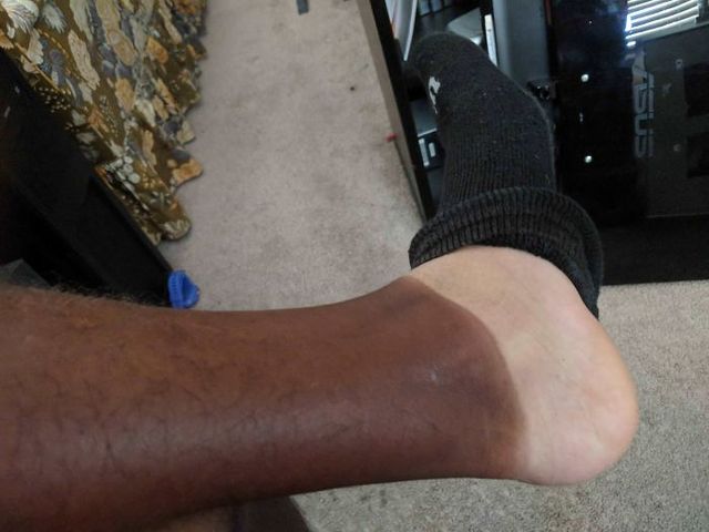 Користувачі мережі діляться смішними фото своєї невдалої засмаги: весела добірка - фото 421172