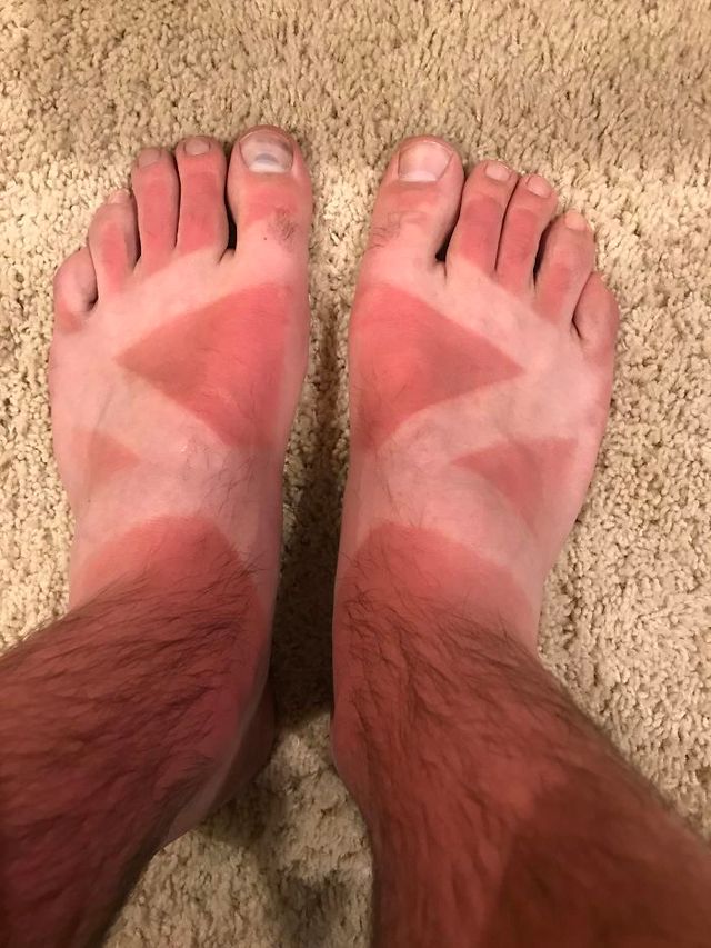 Користувачі мережі діляться смішними фото своєї невдалої засмаги: весела добірка - фото 421187