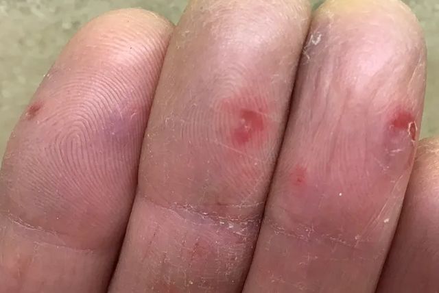 'Ковідні пальці': вчені показали, як виглядає ще один нетиповий симптом COVID-19 - фото 433194