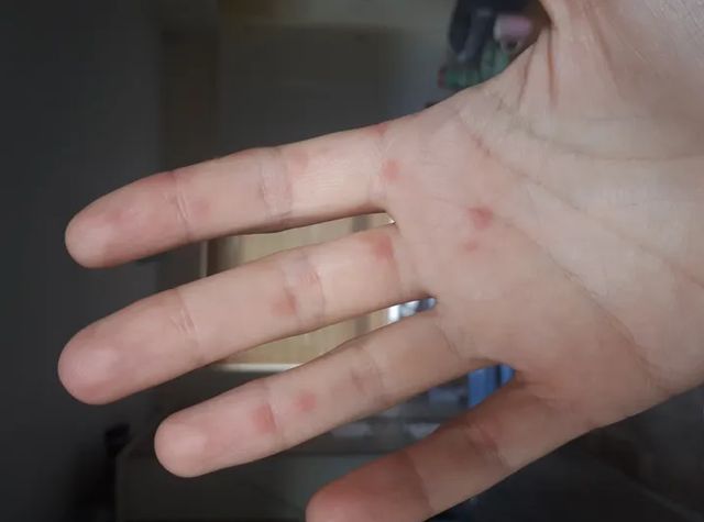 'Ковідні пальці': вчені показали, як виглядає ще один нетиповий симптом COVID-19 - фото 433195