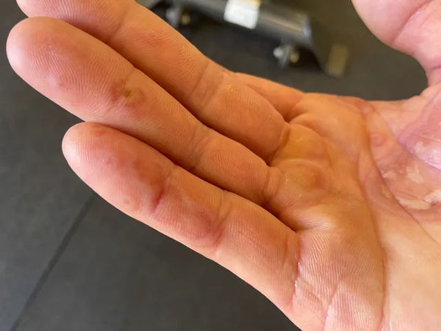 'Ковідні пальці': вчені показали, як виглядає ще один нетиповий симптом COVID-19 - фото 433196