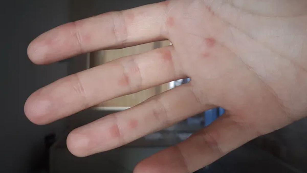 "Ковідні пальці": вчені показали, як виглядає ще один нетиповий симптом COVID-19