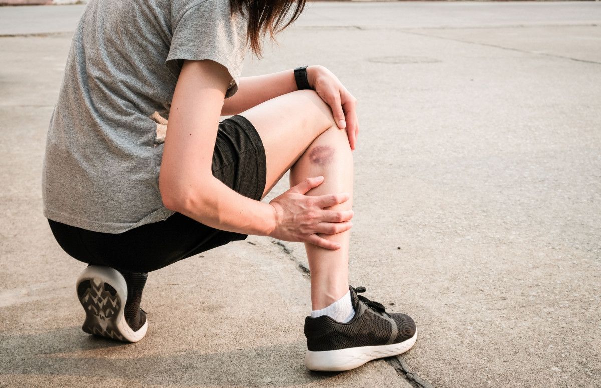 Синці та забої: як швидко вилікувати гематому