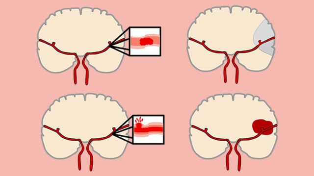 Інсульт- фото 471359
