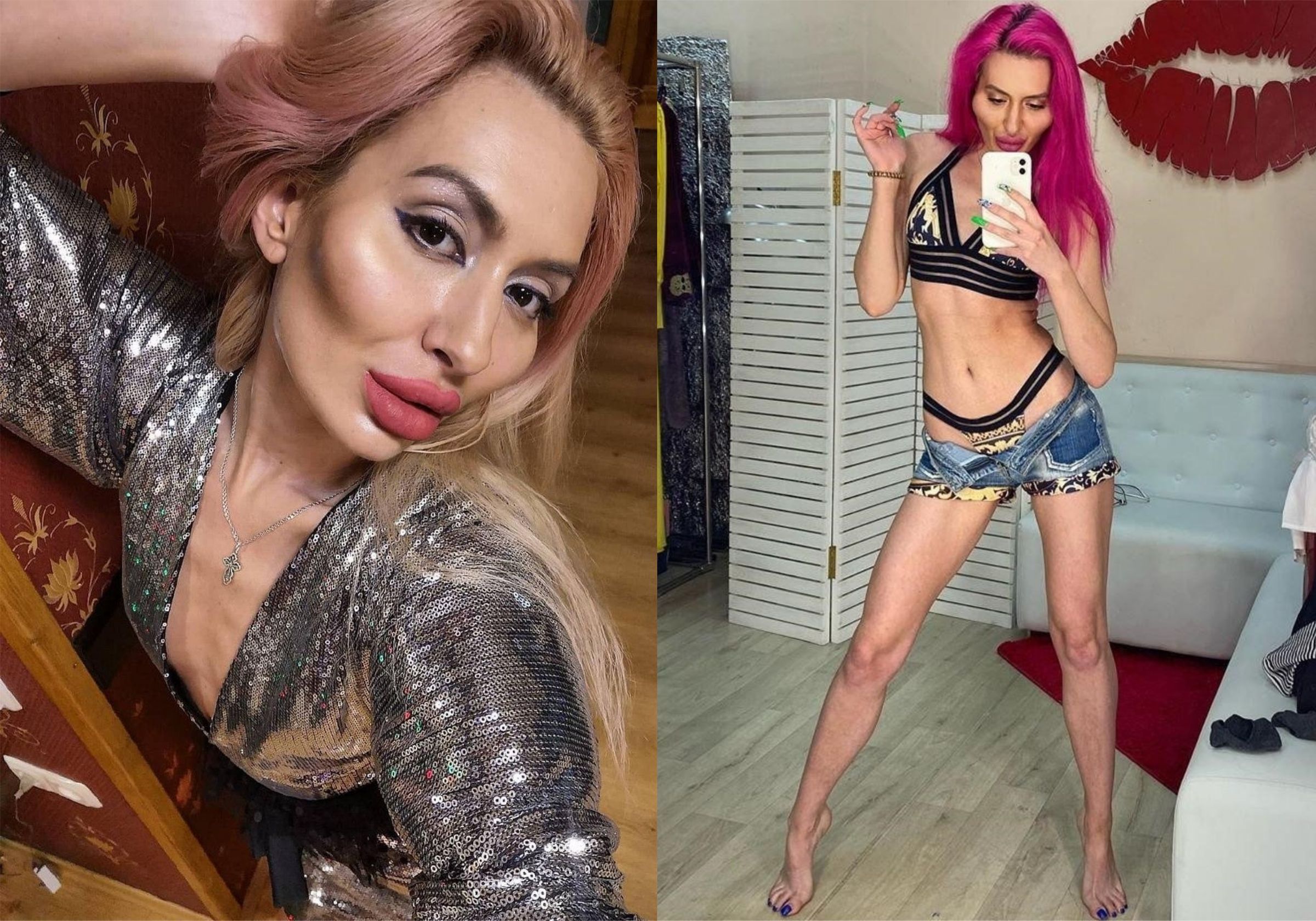 Українка з найбільшими вилицями у світі показала фото до пластики