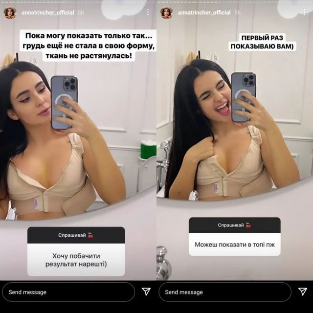 За 6 тисяч доларів: Анна Трінчер вперше показала збільшені груди - фото 492987