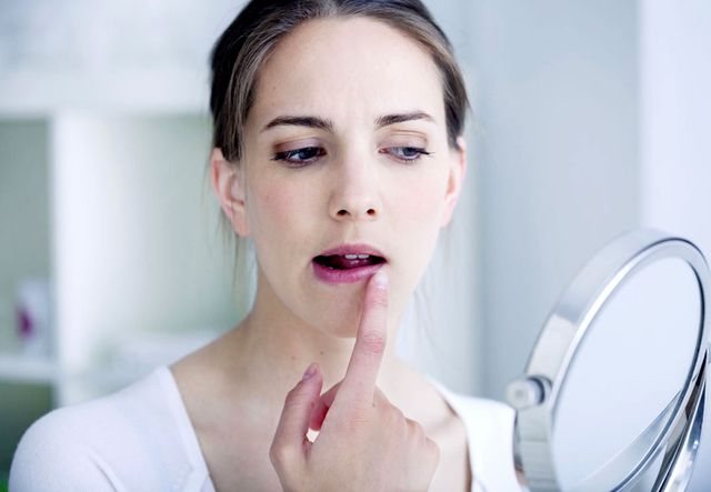 Як швидко вилікувати герпес на губах- фото 493293