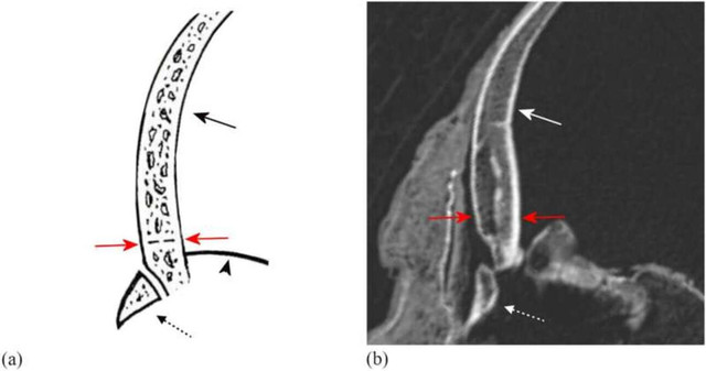 Вимірювання товщини склепіння черепа лобової кістки - фото 524439