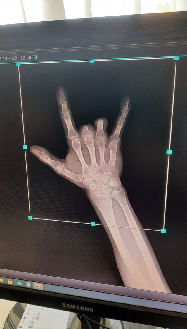 'Життям можна насолоджуватися': як живе захисник після протезування у Вашингтоні - фото 534934