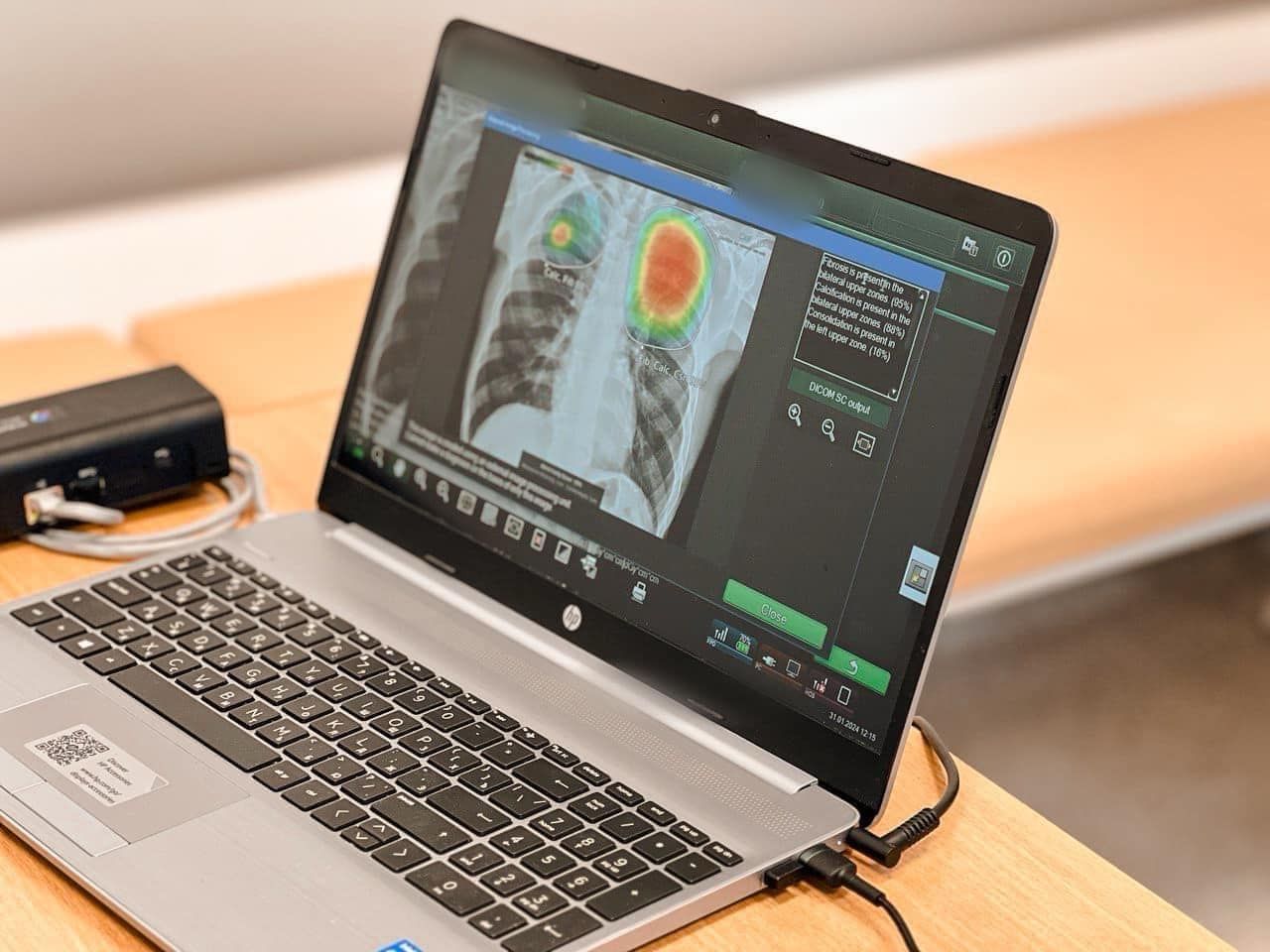 В Україні штучний інтелект аналізуватиме рентгенівські знімки