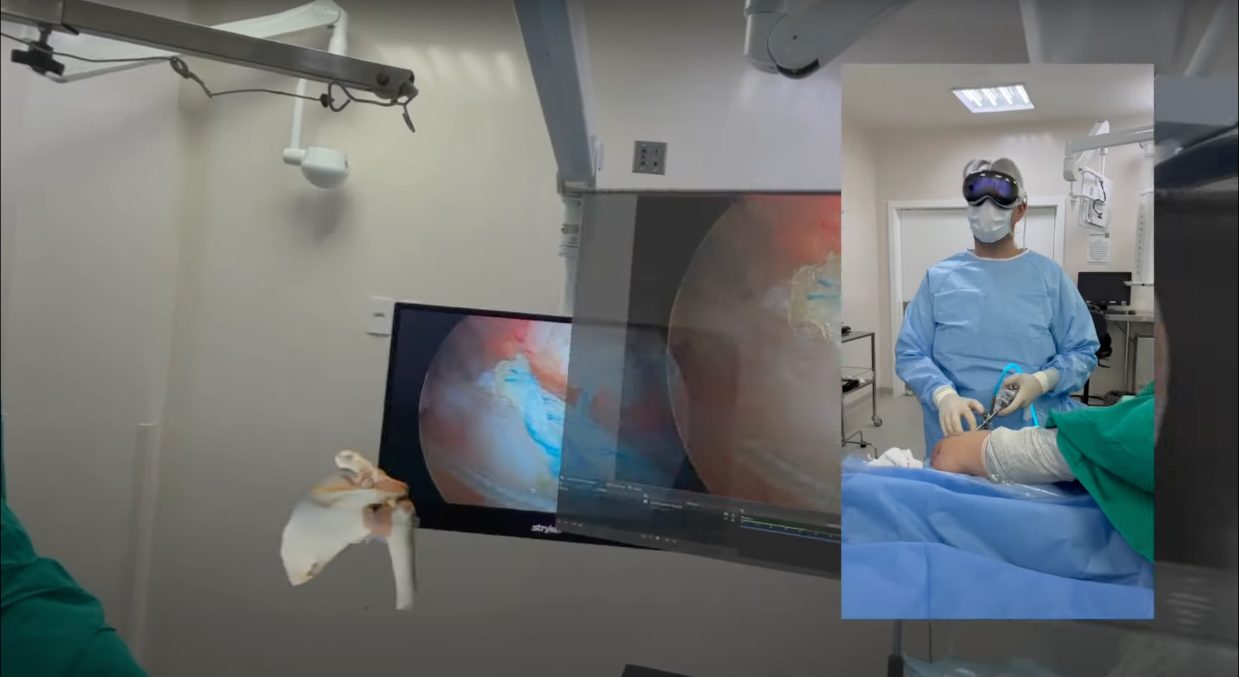 У Бразилії провели операцію з допомогою гарнітури Apple Vision Pro