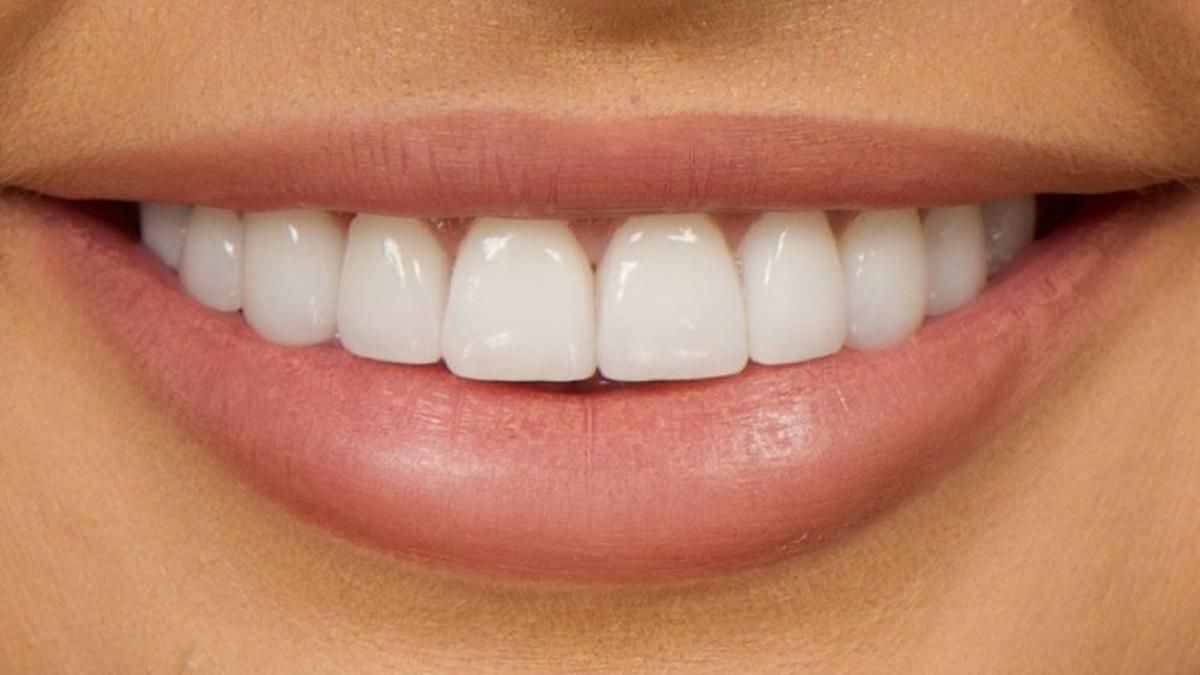 Як роблять вініри: детальний процес встановлення