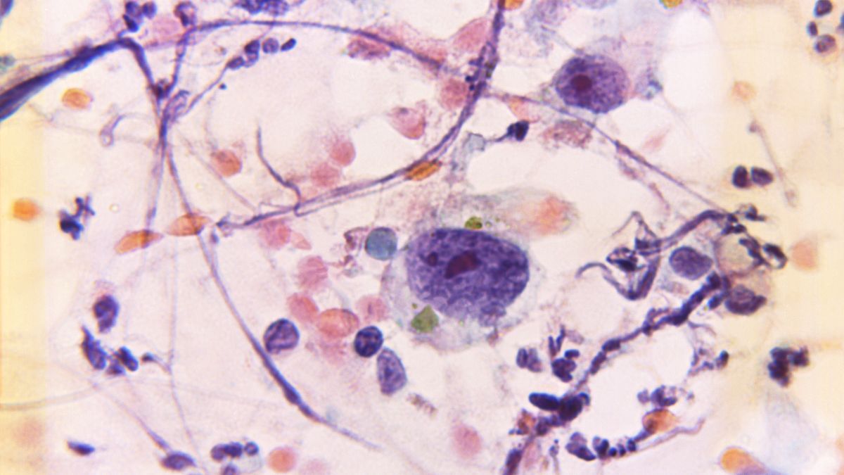 Штучний інтелект навчився виявляти рак з точністю до 99%