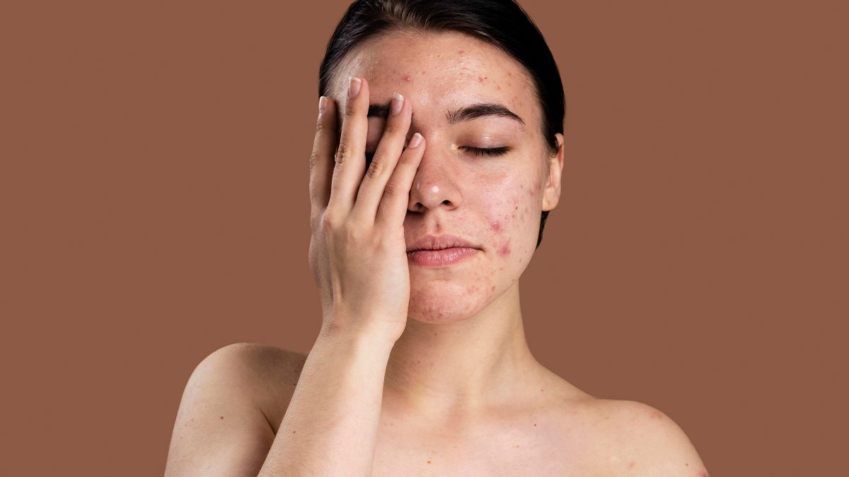Прищі на обличчі: як швидко визначити причину та позбутися їх