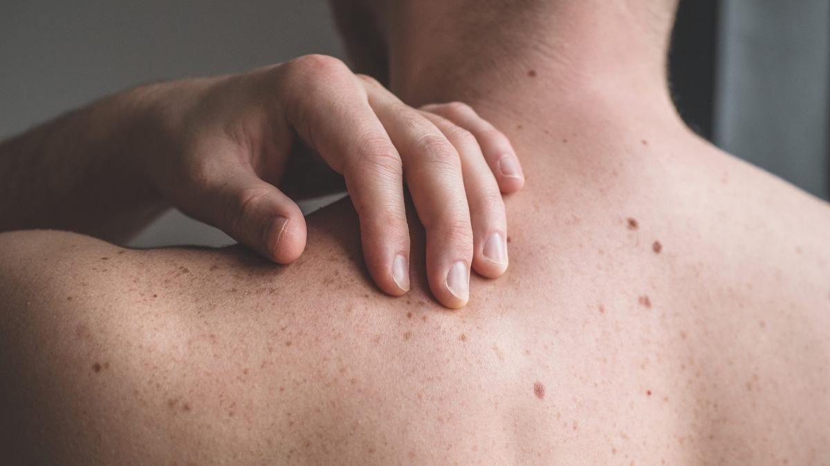 Рак шкіри: типи, симптоми та діагностики - фото 1