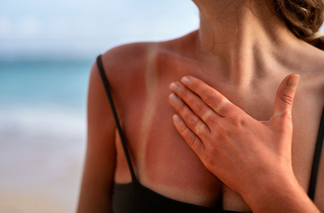 Забудьте про бабусині методи: як не можна лікувати сонячні опіки - фото 558707
