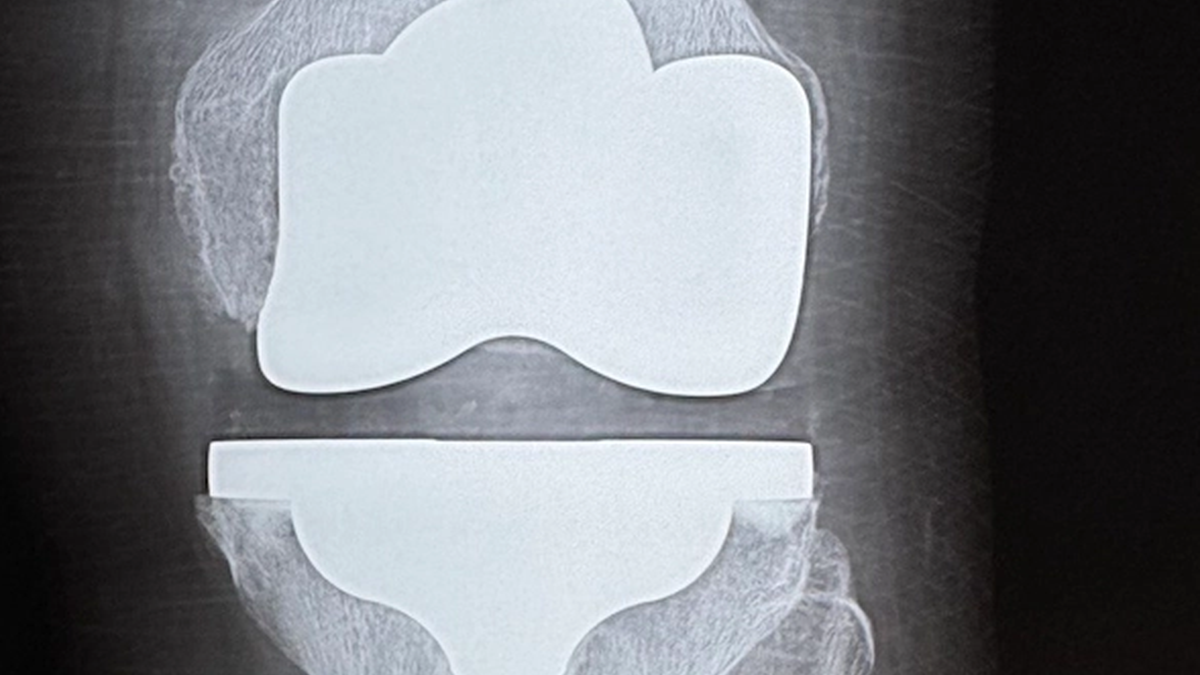 Міфи про ендопротезування: що з них правда, а що — ні - фото 1