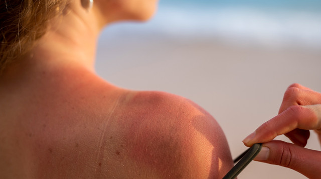 Допомога при сонячних опіках: 6 порад лікаря для швидкого відновлення шкіри - фото 559557