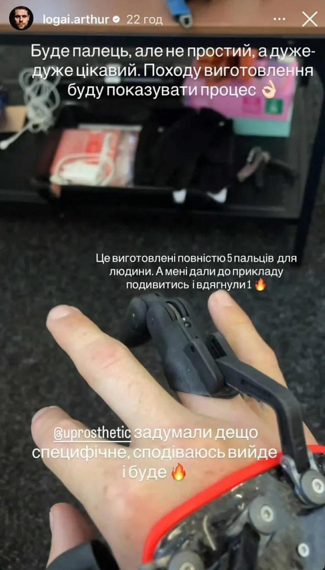 Артур Логай, якому випадково відірвало палець, заінтригував деталями майбутнього протеза - фото 567786