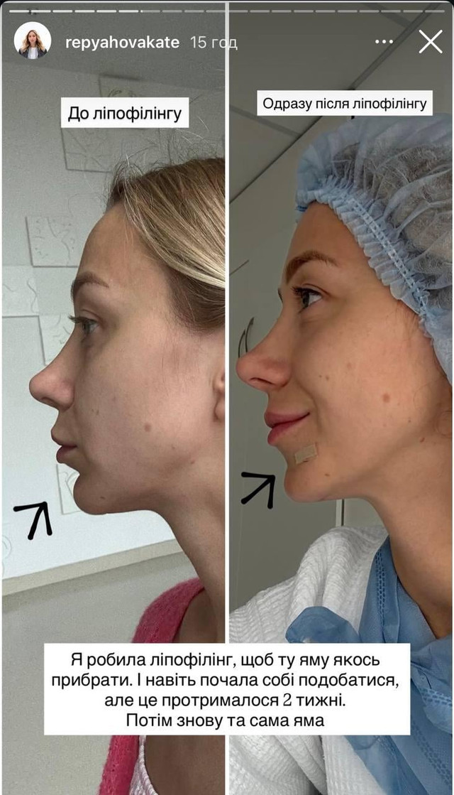 Дружина Віктора Павліка зізналася у невдалій пластичній операції на підборідді - фото 568868