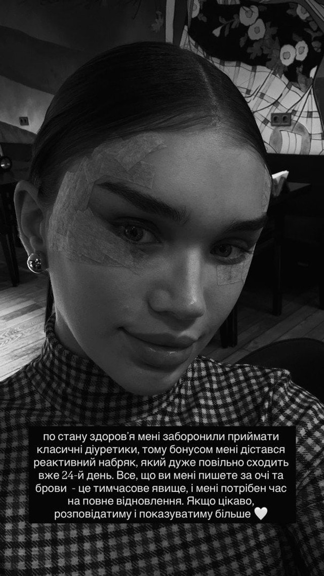 Блогерка-мільйонниця Саша Бо зізналася про пластичну операцію на обличчі - фото 571610