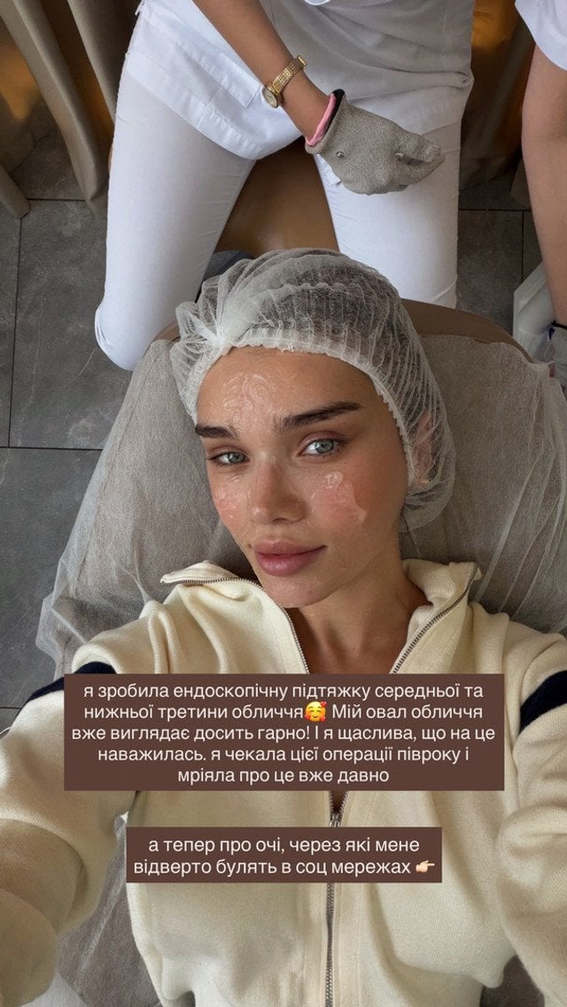 Блогерка-мільйонниця Саша Бо зізналася про пластичну операцію на обличчі - фото 571611