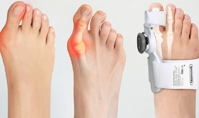 Вальгусна шина: що це, як працює і кому підходить - фото 611773